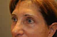 Eyelid Lift