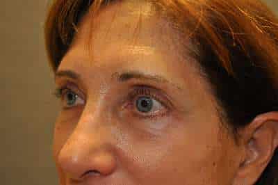 Eyelid Lift