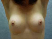 Breast Augmentation