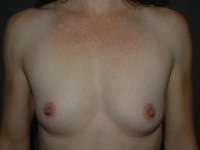 Breast Augmentation