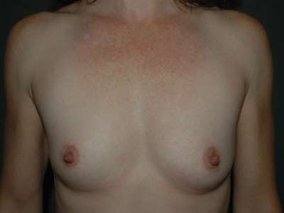 Breast Augmentation Case 4600 Before Photo Breast Augmentation