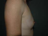 Breast Augmentation