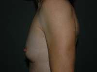 Breast Augmentation