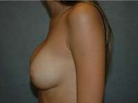 Breast Augmentation