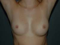 Breast Augmentation