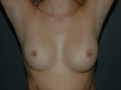 Breast Augmentation