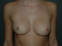 Breast Augmentation