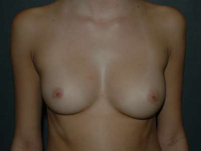 Breast Augmentation Case 4648 Before Photo Breast Augmentation