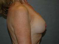 Breast Augmentation