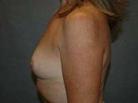 Breast Augmentation