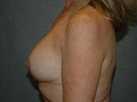 Breast Augmentation