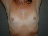 Breast Augmentation