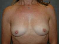 Breast Augmentation