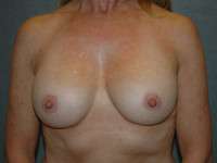 Breast Augmentation