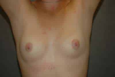 Breast Augmentation