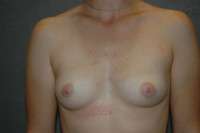 Breast Augmentation