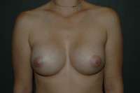 Breast Augmentation