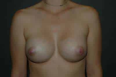Breast Augmentation