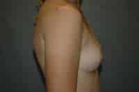 Breast Augmentation