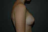 Breast Augmentation