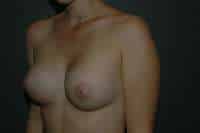 Breast Augmentation