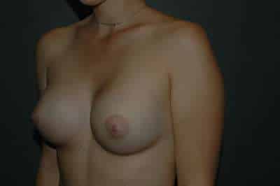 Breast Augmentation