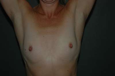 Breast Augmentation