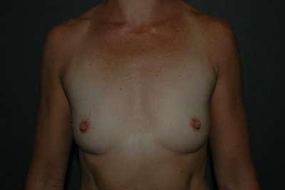 Breast Augmentation Case 4778 Before Photo Breast Augmentation