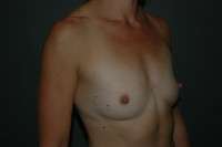 Breast Augmentation