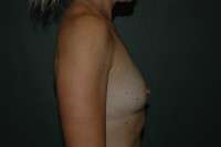 Breast Augmentation