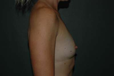 Breast Augmentation