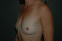 Breast Augmentation