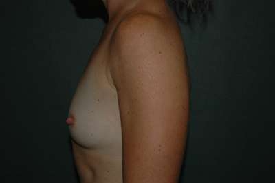 Breast Augmentation