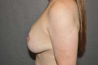 Breast Augmentation with Mastopexy