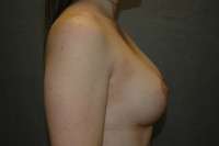 Breast Augmentation with Mastopexy