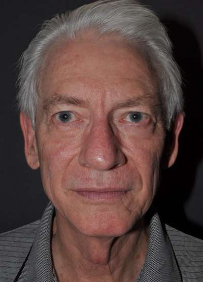 Facelift