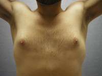 Gynecomastia