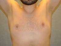 Gynecomastia