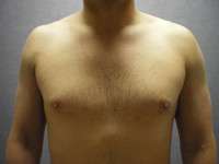 Gynecomastia