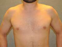 Gynecomastia