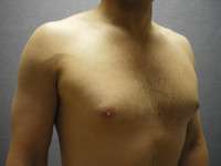 Gynecomastia