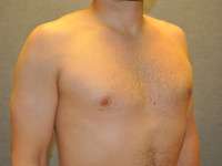 Gynecomastia