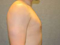 Gynecomastia