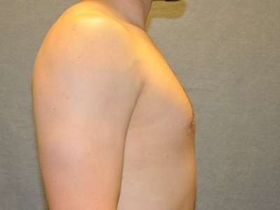 Gynecomastia