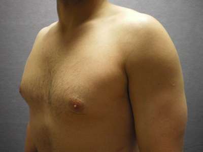 Gynecomastia