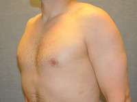 Gynecomastia