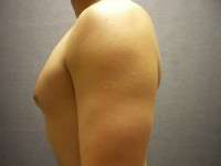 Gynecomastia