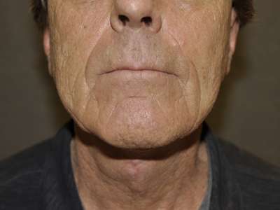 Neck Lift Case 4912 After Photo Neck Lift