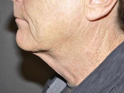 Neck Lift