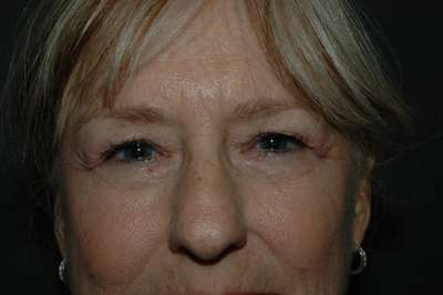 Rhinoplasty Case 4941 Before Photo Rhinoplasty
